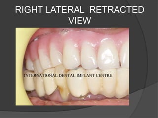 RIGHT LATERAL RETRACTED
VIEW
 