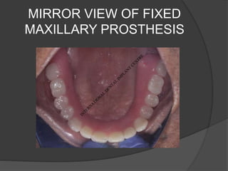 MIRROR VIEW OF FIXED
MAXILLARY PROSTHESIS
 