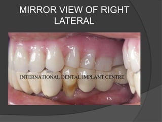 MIRROR VIEW OF RIGHT
LATERAL
 