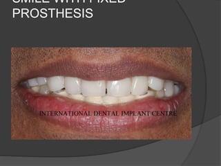 SMILE WITH FIXED
PROSTHESIS
 