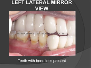 LEFT LATERAL MIRROR
VIEW
Teeth with bone loss present
 