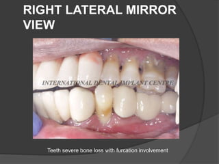 RIGHT LATERAL MIRROR
VIEW
Teeth severe bone loss with furcation involvement
 