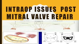 INTRAOP ISSUES POST
MITRAL VALVE REPAIR
 
