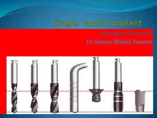 Immediate single implant case presentation | PPTX