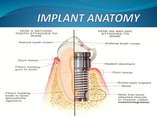Immediate single implant case presentation | PPTX