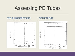 Assessing PE Tubes
TYPE B (BLOCKED PE TUBE) PATENT PE TUBE
 