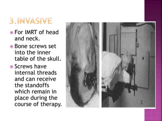  For IMRT of head
and neck.
 Bone screws set
into the inner
table of the skull.
 Screws have
internal threads
and can receive
the standoffs
which remain in
place during the
course of therapy.
 