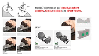 Flexion/extension as per individual patient
anatomy, tumour location and target volume.
 