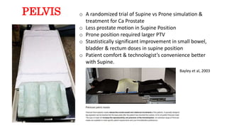 PELVIS o A randomized trial of Supine vs Prone simulation &
treatment for Ca Prostate
o Less prostate motion in Supine Position
o Prone position required larger PTV
o Stastistically significant improvement in small bowel,
bladder & rectum doses in supine position
o Patient comfort & technologist’s convenience better
with Supine.
Bayley et al, 2003
 