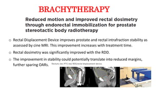 o Rectal Displacement Device improves prostate and rectal intrafraction stability as
assessed by cine MRI. This improvement increases with treatment time.
o Rectal dosimetry was significantly improved with the RDD.
o The improvement in stability could potentially translate into reduced margins,
further sparing OARs.
BRACHYTHERAPY
 
