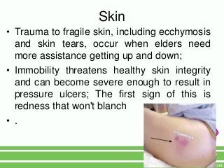 Skin
• Trauma to fragile skin, including ecchymosis
  and skin tears, occur when elders need
  more assistance getting up and down;
• Immobility threatens healthy skin integrity
  and can become severe enough to result in
  pressure ulcers; The first sign of this is
  redness that won't blanch
• .
 