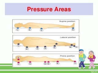 Pressure Areas
 
