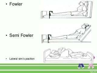 • Fowler




• Semi Fowler




•   Lateral sim’s position
 