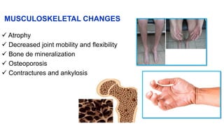 MUSCULOSKELETAL CHANGES
 Atrophy
 Decreased joint mobility and flexibility
 Bone de mineralization
 Osteoporosis
 Contractures and ankylosis
 