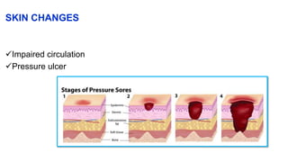 SKIN CHANGES
Impaired circulation
Pressure ulcer
 