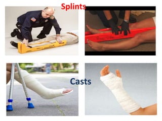 Immobilization splints | PPTX