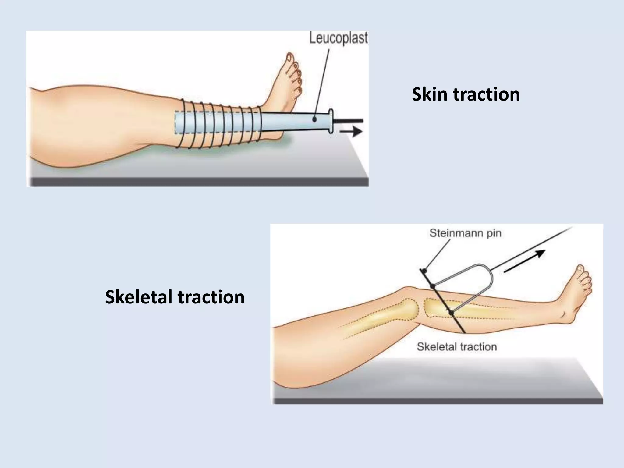 Immobilization used in Musculoskeletal injuries | PPTX
