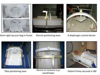 A diaphragm control deviceSemi-rigid vacuum bag in frame Sternal positioning laser
Tibia positioning laser Patient firmly secured in SBFDevice to measure x,y,z
coordinates
 
