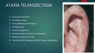 ATAXIA TELANGIECTASIA
 Autosomal recessive
 Cerebellar ataxia
 Chorioatethoid movements
 Telengiectasia
 Ovarian dysgenesis
 Sinopulmonary infection & malignancy
 Absence of IgA & low IgE
 Transfer factor therapy and fetal thymus transplants
 
