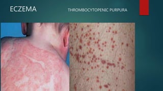ECZEMA THROMBOCYTOPENIC PURPURA
 
