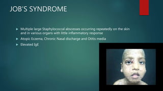 JOB’S SYNDROME
 Multiple large Staphylococcal abscesses occurring repeatedly on the skin
and in various organs with little inflammatory response
 Atopic Eczema, Chronic Nasal discharge and Otitis media
 Elevated IgE
 