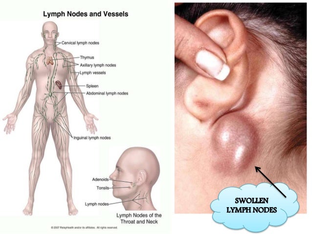 biology immune suppression hiv swollen lymph nodes hiv