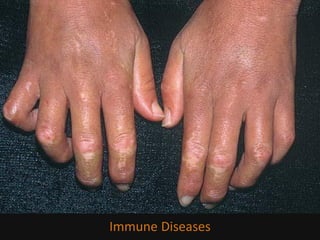 Immune Diseases
 