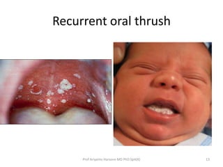 Recurrent oral thrush

Prof Ariyanto Harsono MD PhD SpA(K)

13

 