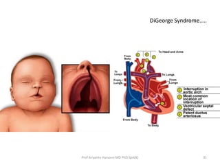 DiGeorge Syndrome…..

Prof Ariyanto Harsono MD PhD SpA(K)

31

 