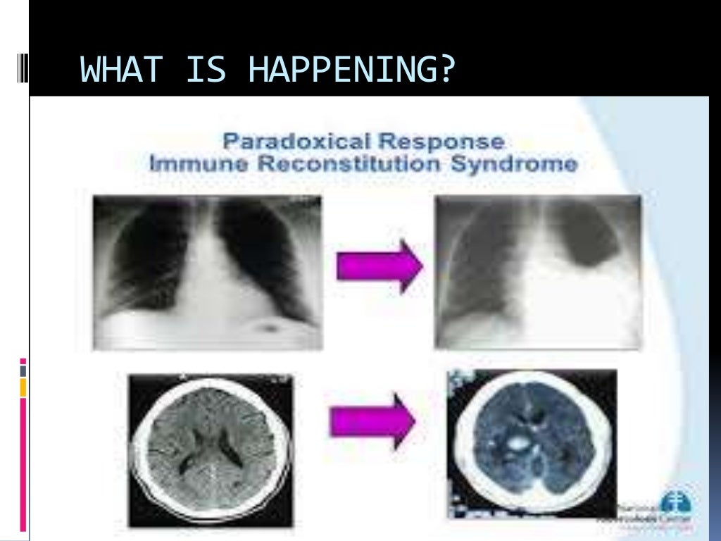 oppurtunistic infection in HIV/AIDS AND IRIS