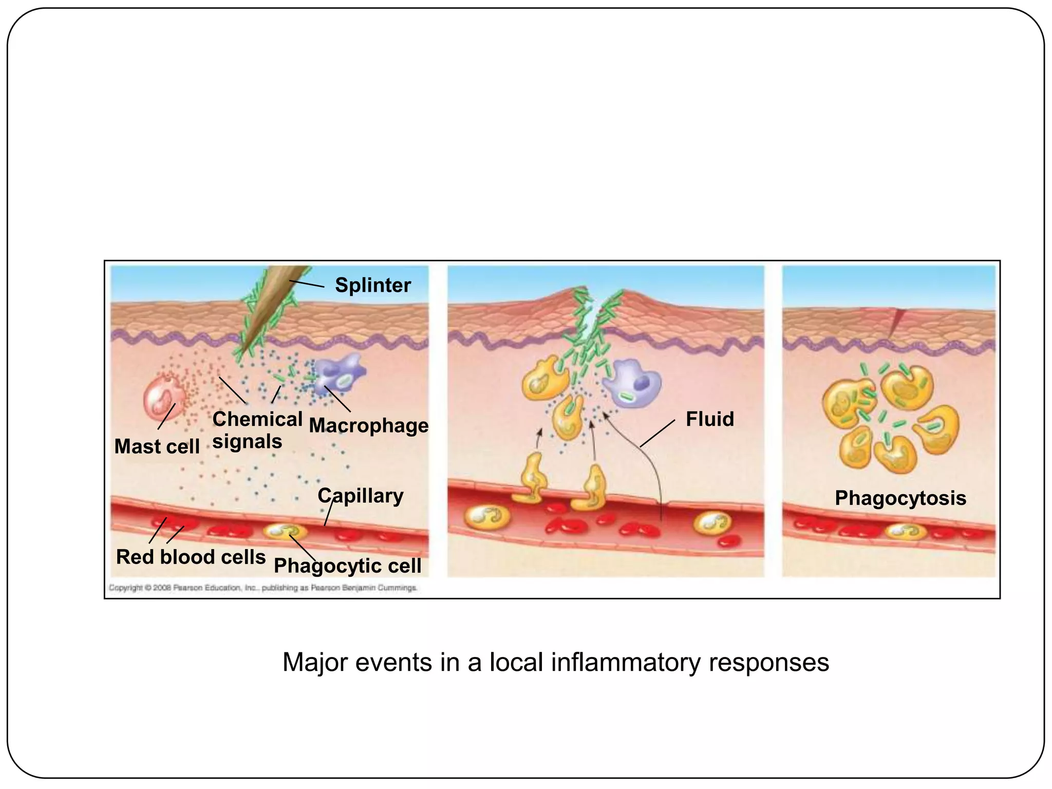 Splinter




          Chemical Macrophage                    Fluid
Mast cell signals

                    Capillary                                    Phagocytosis

Red blood cells Phagocytic cell




                Major events in a local inflammatory responses
 