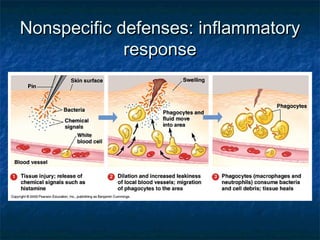Nonspecific defenses: inflammatoryNonspecific defenses: inflammatory
responseresponse
 