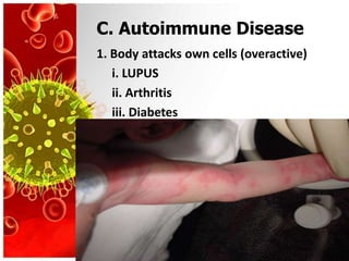 C. Autoimmune Disease
1. Body attacks own cells (overactive)
   i. LUPUS
   ii. Arthritis
   iii. Diabetes
 