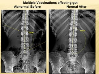 Multiple Vaccinations affecting gut
Abnormal Before Normal After
 