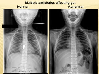 Multiple antibiotics affecting gut
Normal Abnormal
 
