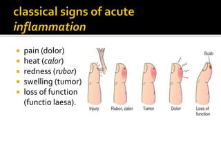    pain (dolor)
   heat (calor)
   redness (rubor)
   swelling (tumor)
   loss of function
    (functio laesa).
 