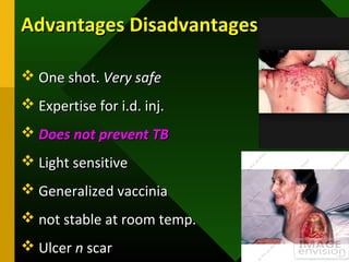 Advantages DisadvantagesAdvantages Disadvantages
 One shot.One shot. Very safeVery safe
 Expertise for i.d. inj.Expertise for i.d. inj.
 Does not prevent TBDoes not prevent TB
 Light sensitiveLight sensitive
 Generalized vacciniaGeneralized vaccinia
 not stable at room temp.not stable at room temp.
 UlcerUlcer nn scarscar
 
