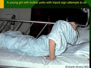 A young girl with bulbar polio with tripod sign attempts to sitA young girl with bulbar polio with tripod sign attempts to sit
 