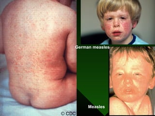 Measles
German measles
 