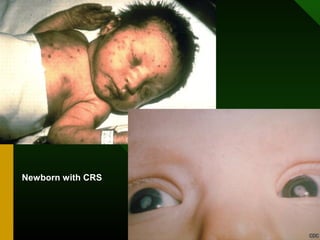 Newborn with CRS
 