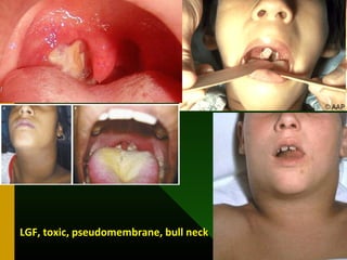 LGF, toxic, pseudomembrane, bull neckLGF, toxic, pseudomembrane, bull neck
 