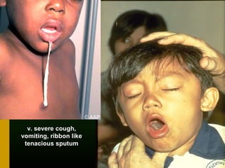 v. severe cough,v. severe cough,
vomiting, ribbon likevomiting, ribbon like
tenacious sputumtenacious sputum
 