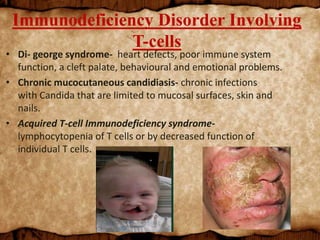 Immunodeficiency Disorder Involving
T-cells
• Di- george syndrome- heart defects, poor immune system
function, a cleft palate, behavioural and emotional problems.
• Chronic mucocutaneous candidiasis- chronic infections
with Candida that are limited to mucosal surfaces, skin and
nails.
• Acquired T-cell Immunodeficiency syndrome-
lymphocytopenia of T cells or by decreased function of
individual T cells.
 
