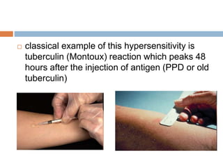 classical example of this hypersensitivity is
tuberculin (Montoux) reaction which peaks 48
hours after the injection of antigen (PPD or old
tuberculin)
 