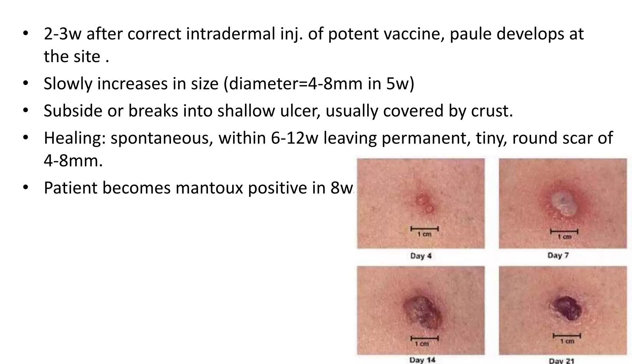 • 2-3w after correct intradermal inj. of potent vaccine, paule develops at
the site .
• Slowly increases in size (diameter=4-8mm in 5w)
• Subside or breaks into shallow ulcer, usually covered by crust.
• Healing: spontaneous, within 6-12w leaving permanent, tiny, round scar of
4-8mm.
• Patient becomes mantoux positive in 8w.
 