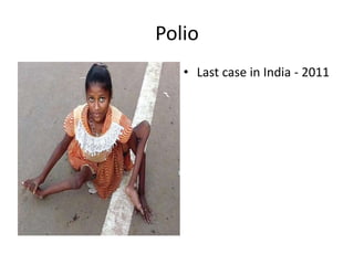 Polio
• Last case in India - 2011
 