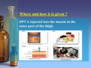 Where and how it is given ?
DPT is injected into the muscle in the
outer part of the thigh.
 