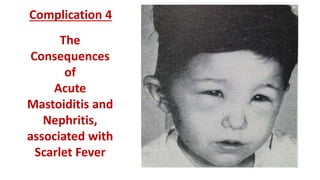 Also linked to the onset
of a gangrenous state in
Scarlet Fever patients:
Swelling of the Eyelids
Discharge of the Nose
Fo...