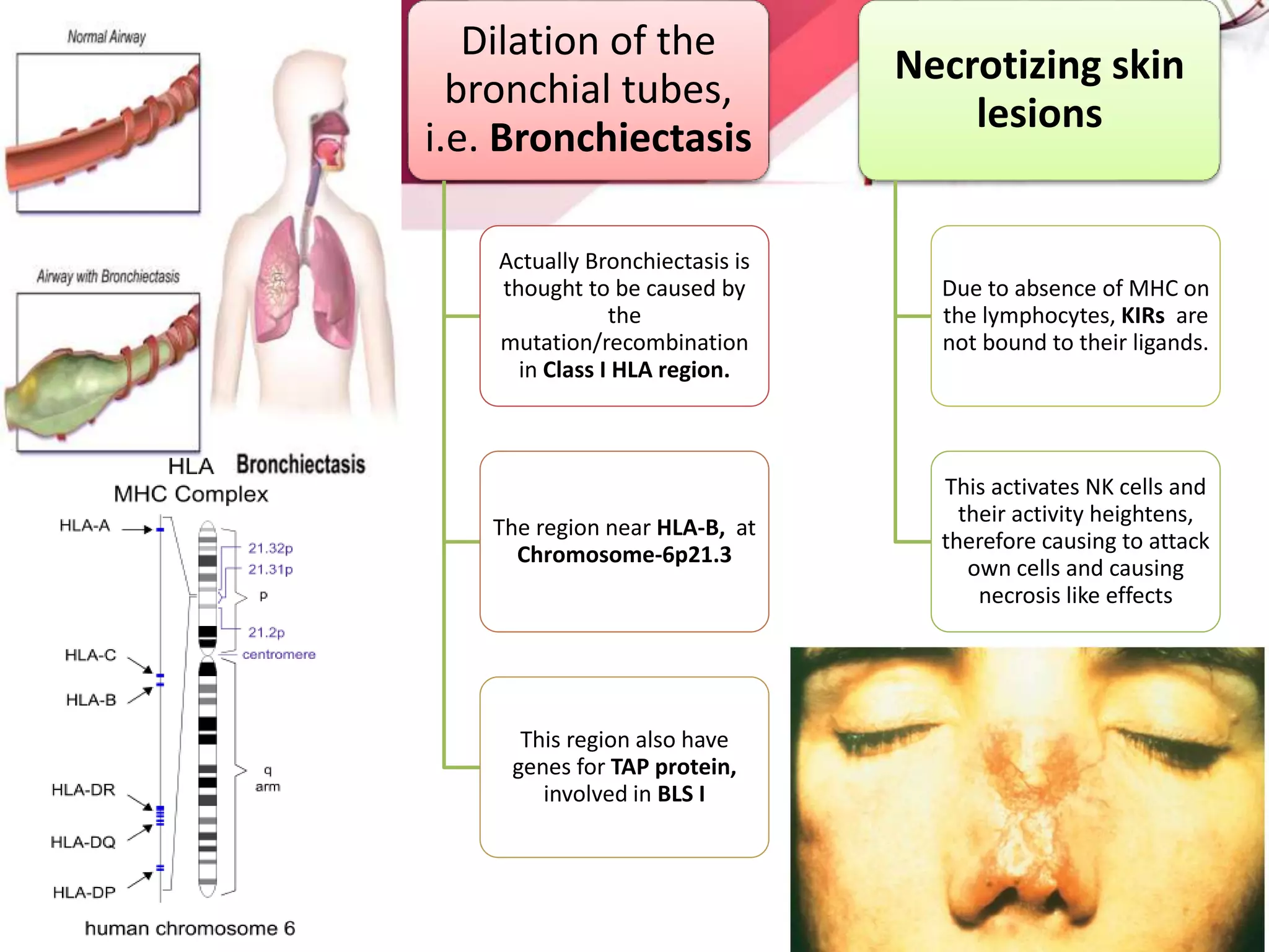 Dilation of the
bronchial tubes,
i.e. Bronchiectasis
Actually Bronchiectasis is
thought to be caused by
the
mutation/recombination
in Class I HLA region.
The region near HLA-B, at
Chromosome-6p21.3
This region also have
genes for TAP protein,
involved in BLS I
Necrotizing skin
lesions
Due to absence of MHC on
the lymphocytes, KIRs are
not bound to their ligands.
This activates NK cells and
their activity heightens,
therefore causing to attack
own cells and causing
necrosis like effects
 