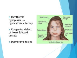 2. Parathyroid
hypoplasia →
hypocalcemic tetany
3. Congenital defect
of heart & blood
vessels
4. Dysmorphic facies
 